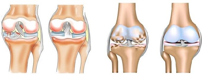 What is arthritis and osteoarthritis